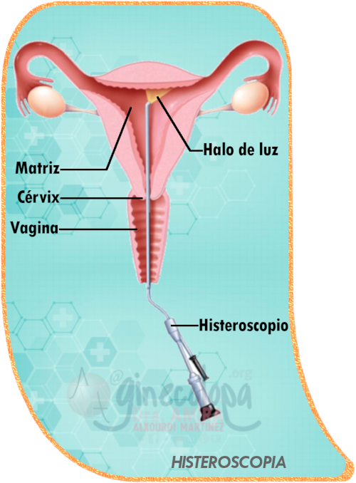 HISTEROSCOPIA VAGINA MIOMAS TOTAL