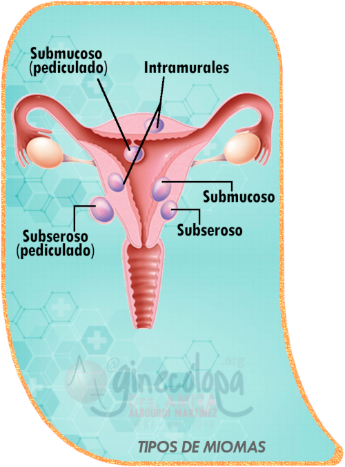 TIPOS DE MIOMAS SUBSEROSOS