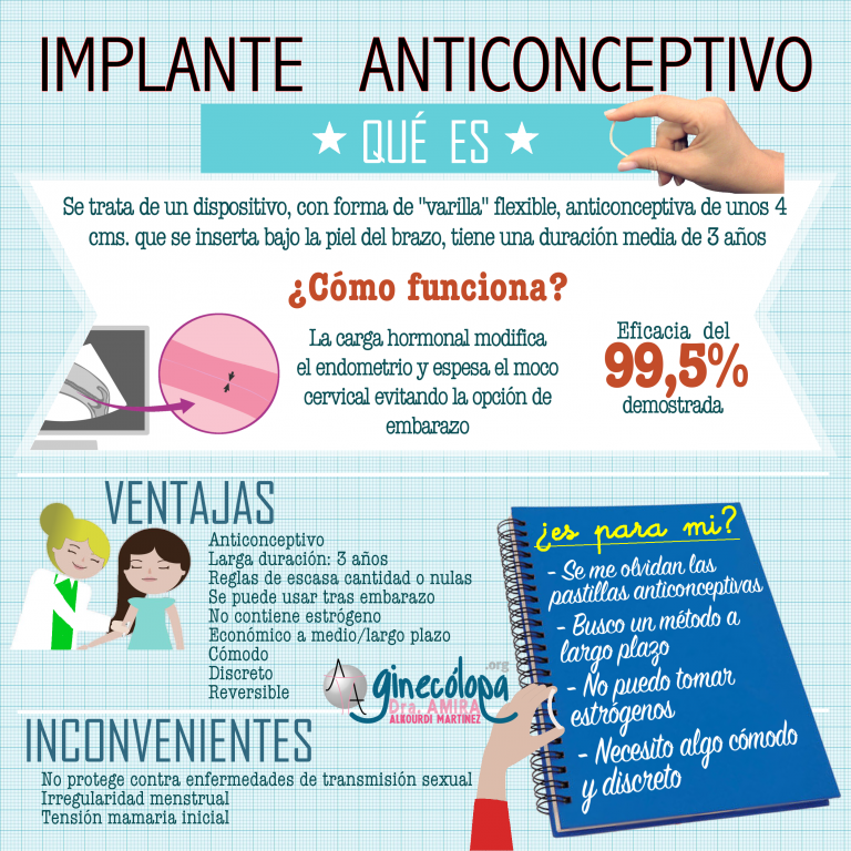 implante-anticonceptivo-de-embarazo-implan-n-v-deo-c-mo-se-coloca-y