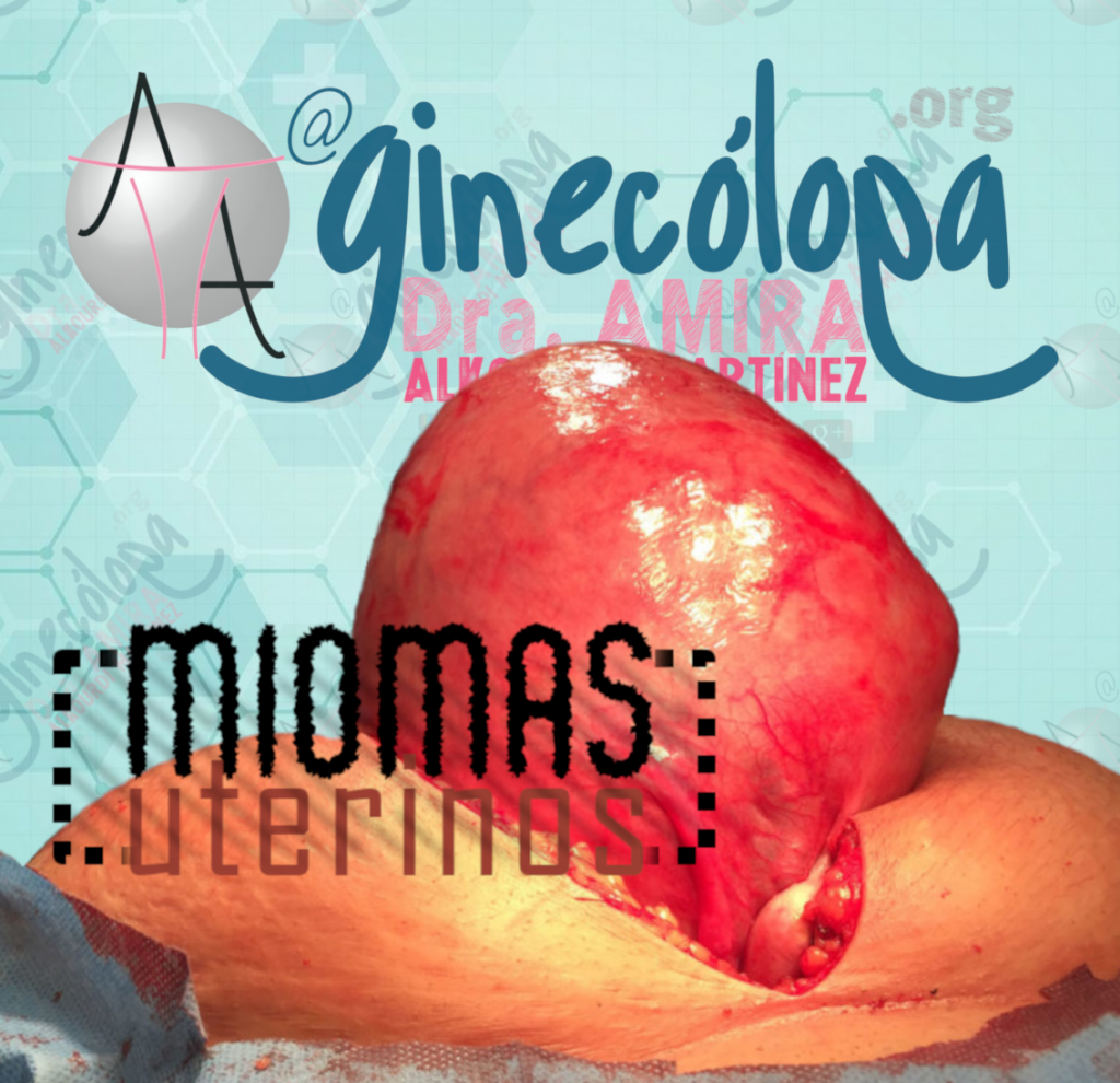 miomas destacado sop endometrio