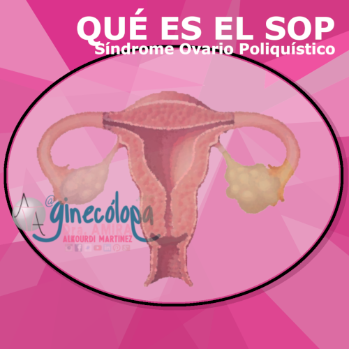 que es el sop sintomas dolor regla fertilidad