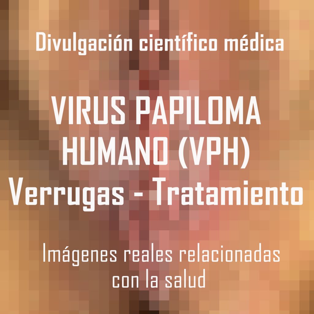 virus papiloma reconcoer verrugas si es por eso vph hpv