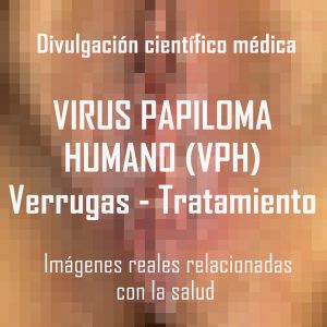 virus papiloma reconcoer verrugas si es por eso vph hpv